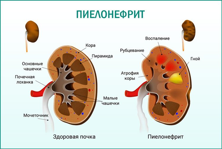 Пиелонефрит