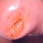 Простая кольпоскопия