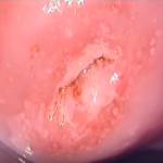 Шейка, обработанная 3%-м раствором уксусной кислоты