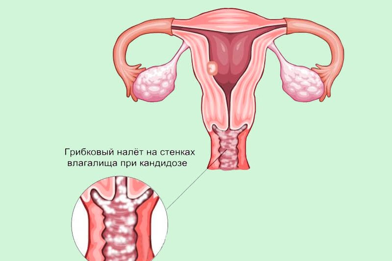 Кандидоз влагалища