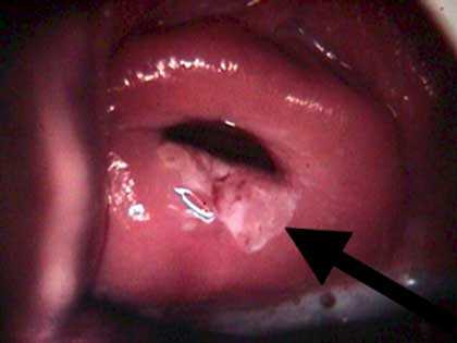 Лейкоплакия шейки матки