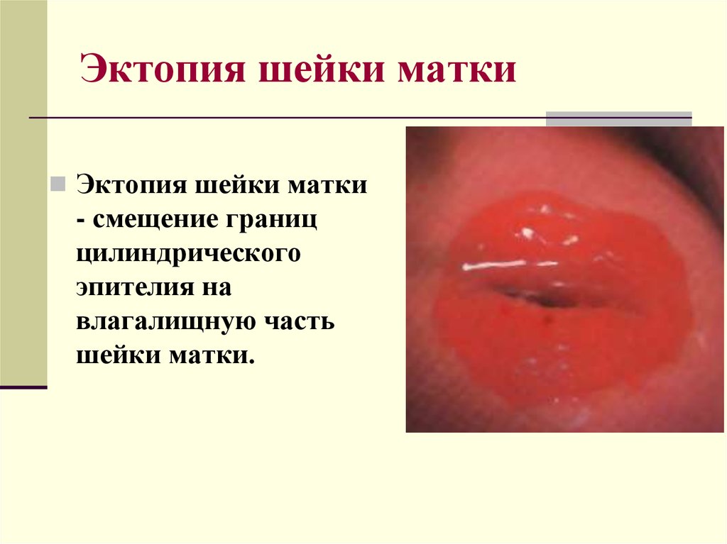 Эктопия шейки матки