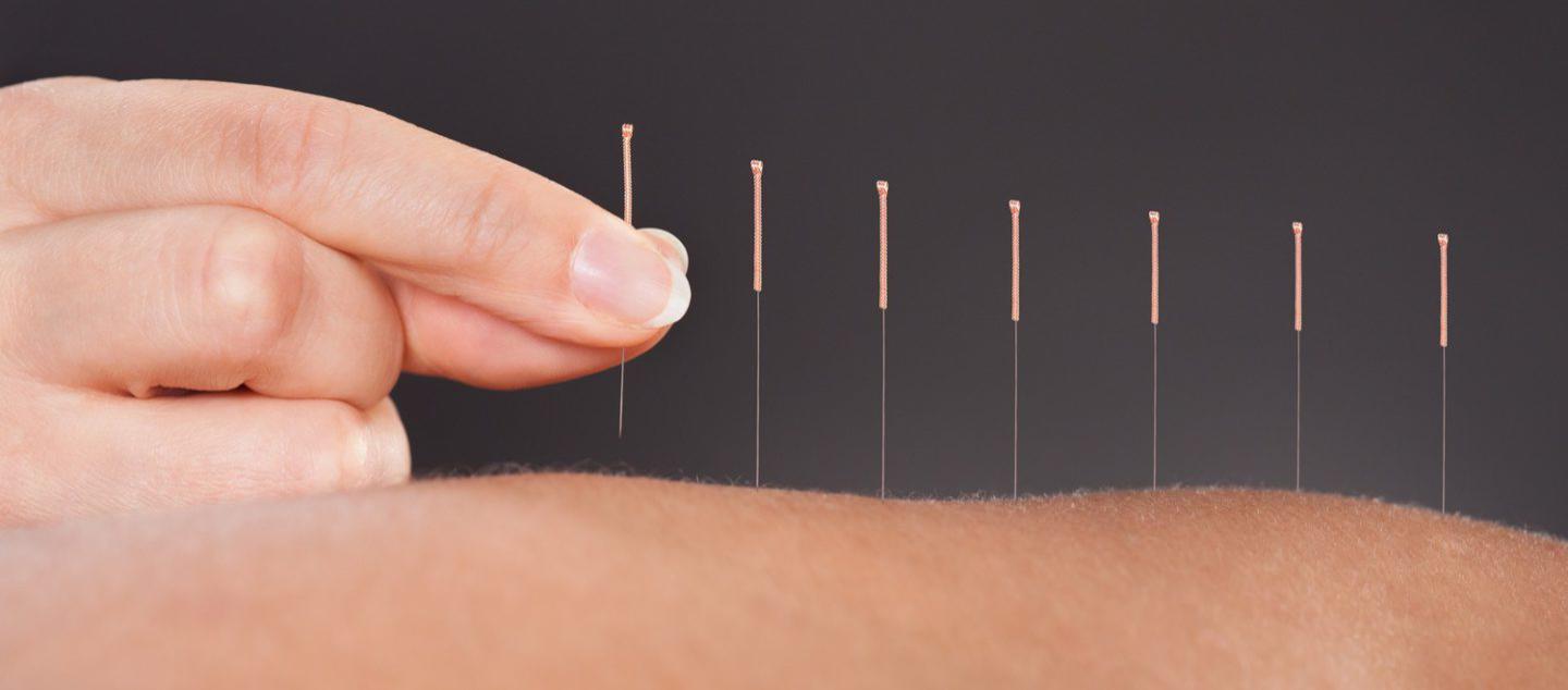 Акупунктура