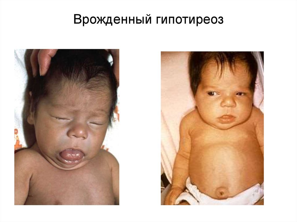 Младенец с врождённым гипотиреозом