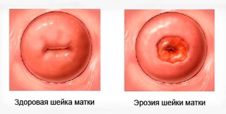 Эрозия шейки матки