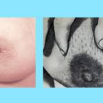 втянутый сосок и симптом «лимонной корки»