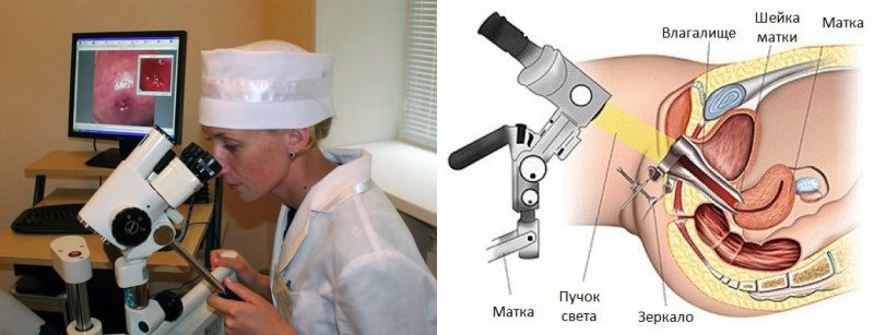 кольпоскопия — ход процедуры