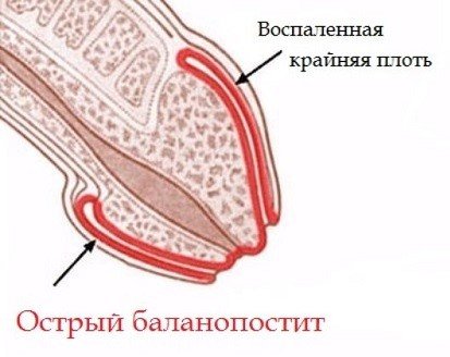 Воспалённая крайняя плоть при остром балапостите