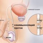 Вазэктомия