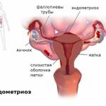 Эндометриоз