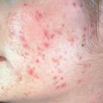 Угревая болезнь