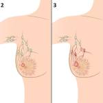 Рак молочной железы по стадиям