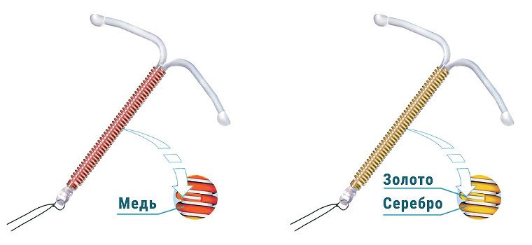 Внутриматочные спирали второго поколения