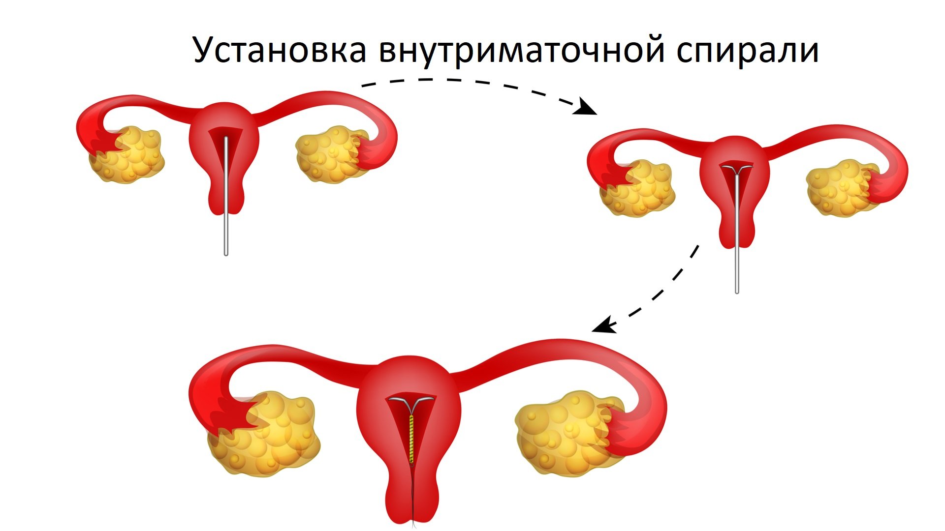 Правильная установка спирали