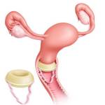 Контрацептивная губка