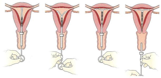 установка внутриматочной спирали рисунок