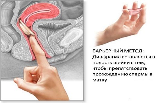 Диафрагма противозачаточная
