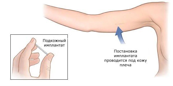 Противозачаточный подкожный имплант