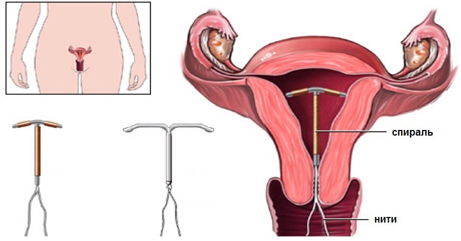 Внутриматочная спираль