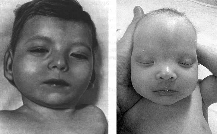 синдром кошачьего крика у новорождённого