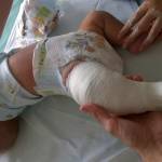 гипсование при косолапости