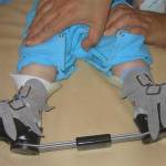 ортопедические брейсы при косолапости