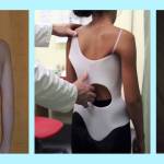 сколиоз, корсет