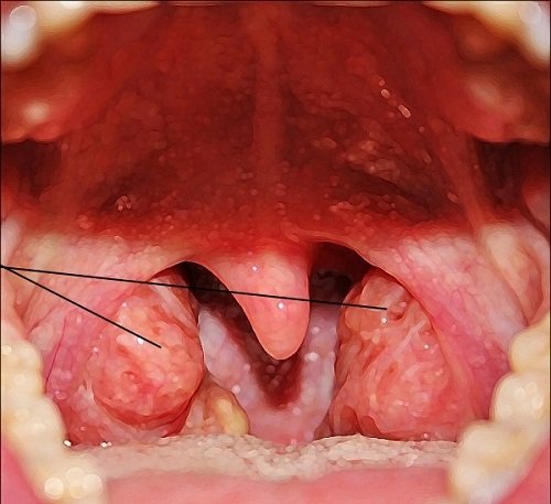 Разросшиеся аденоиды