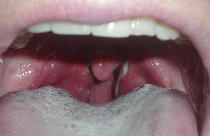 Красное воспалённое горло