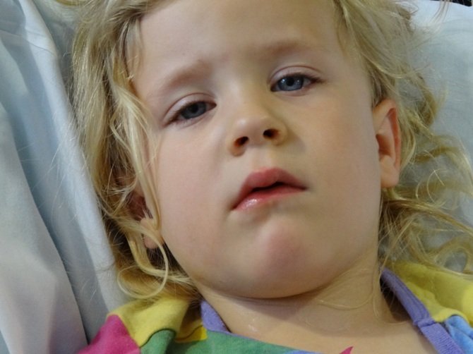 У девочки приоткрыт рот и немного удлинена нижняя челюсть