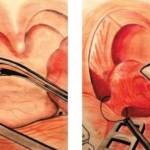 Классическая операция