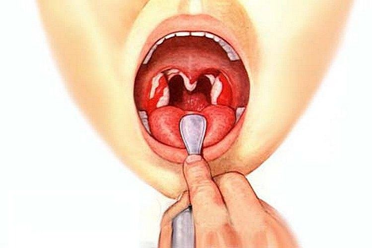 Человеку осматривают горло, оно поражено ларингитом
