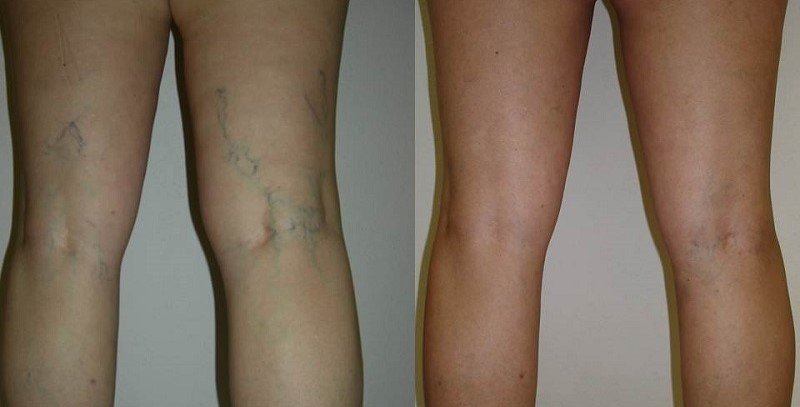 Здоровые ноги и поражённые варикозом