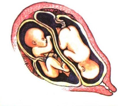 Двойня в утробе