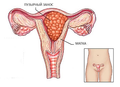 Пузырный занос