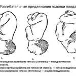 Варианты головного предлежания