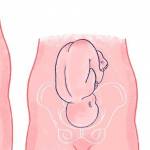 Головное и тазовое предлежание, косое положение