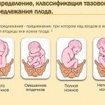 Варианты тазового предлежания