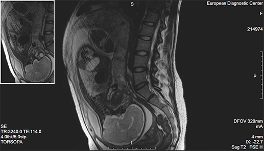 Мрт при беременности