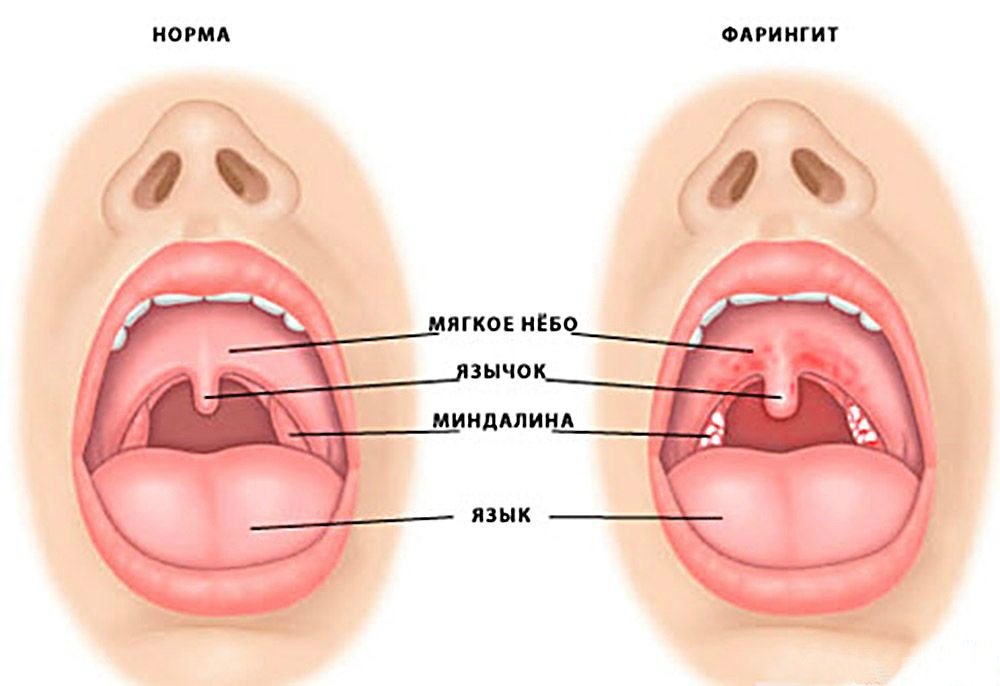 Признаки фарингита