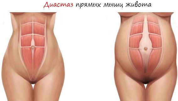 Диастаз на рисунке