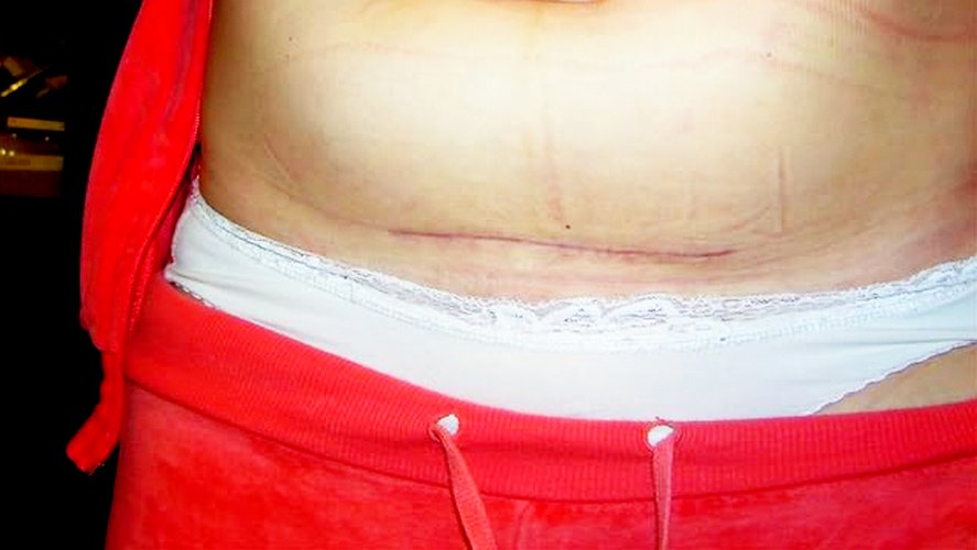 Рубец через год после кесарева сечения