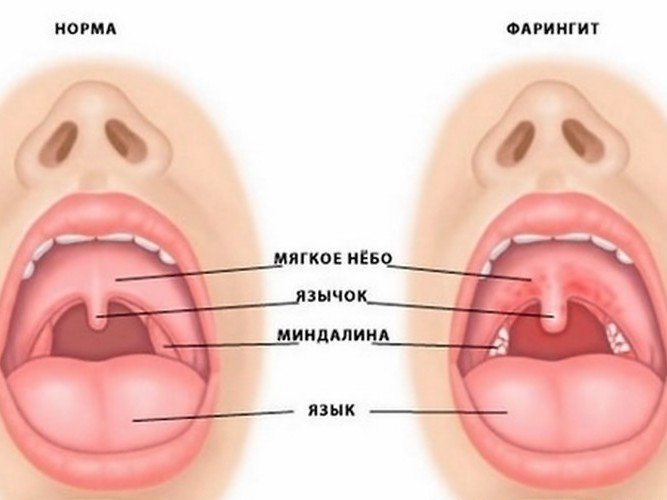 Симптомы острого фарингита у детей