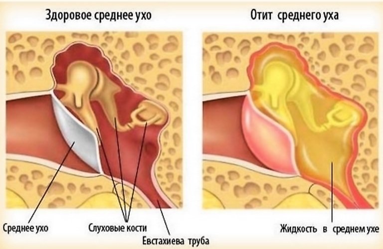 Средний отит у ребёнка