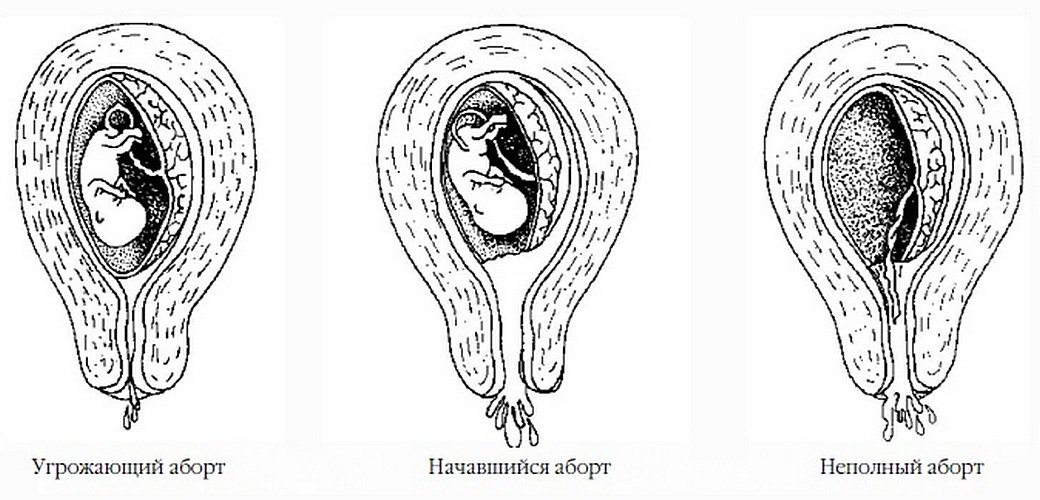 Стадии выкидыша на ранних сроках