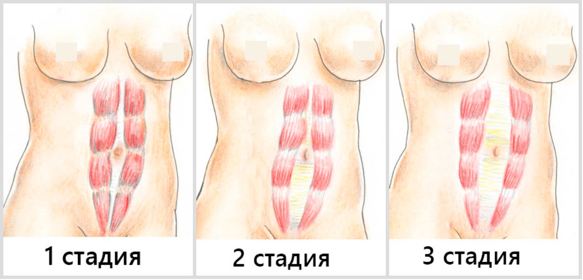 Степени диастаза