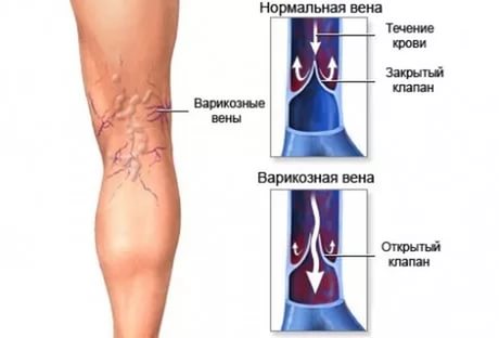 Варикоз при беременности