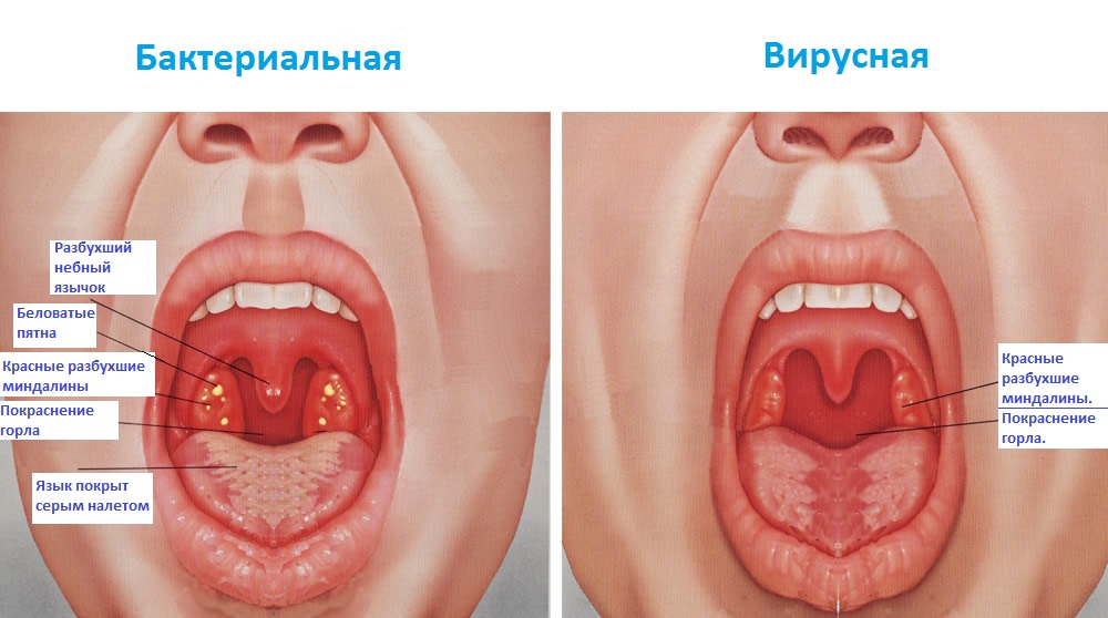 Отличия вирусной и бактериаальной ангины