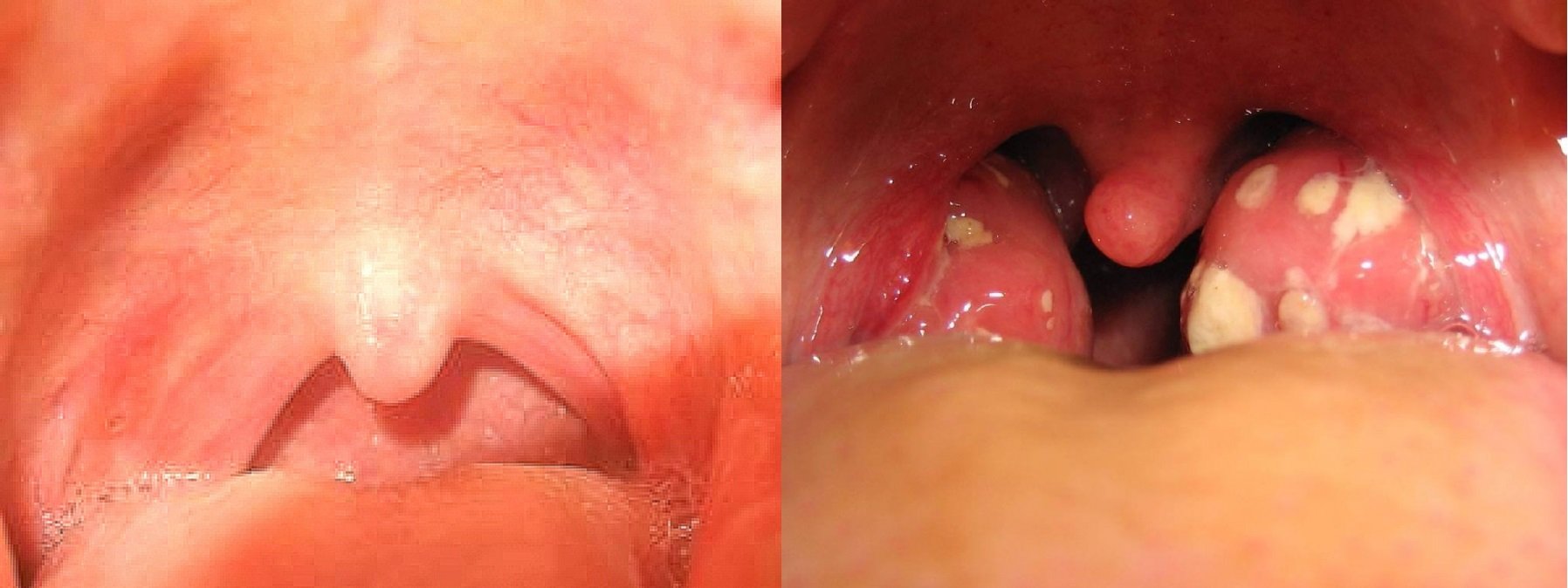 Воспалённые миндалины — ангина