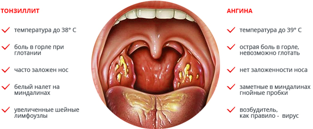 Симптомы ангины и тонзиллита